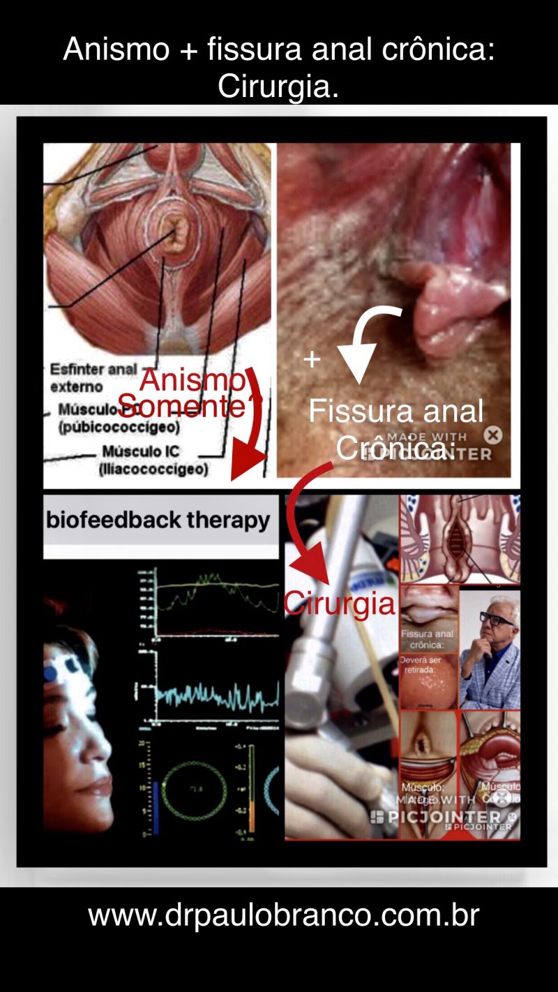 Fissura anal crônica e anismo tratada laser errado Dr Paulo Branco