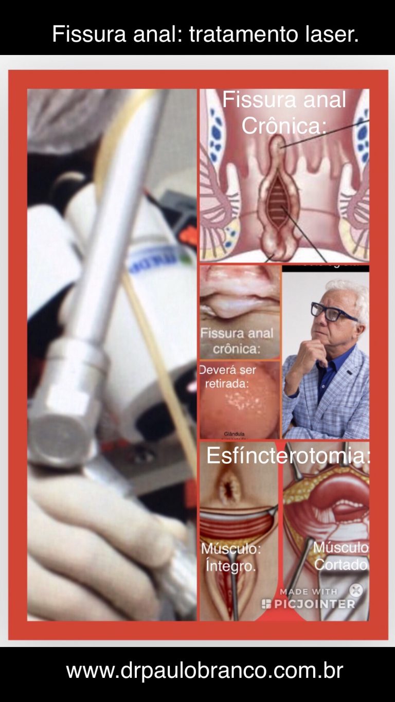 Fissura anal crônica e anismo tratada laser errado Dr Paulo Branco