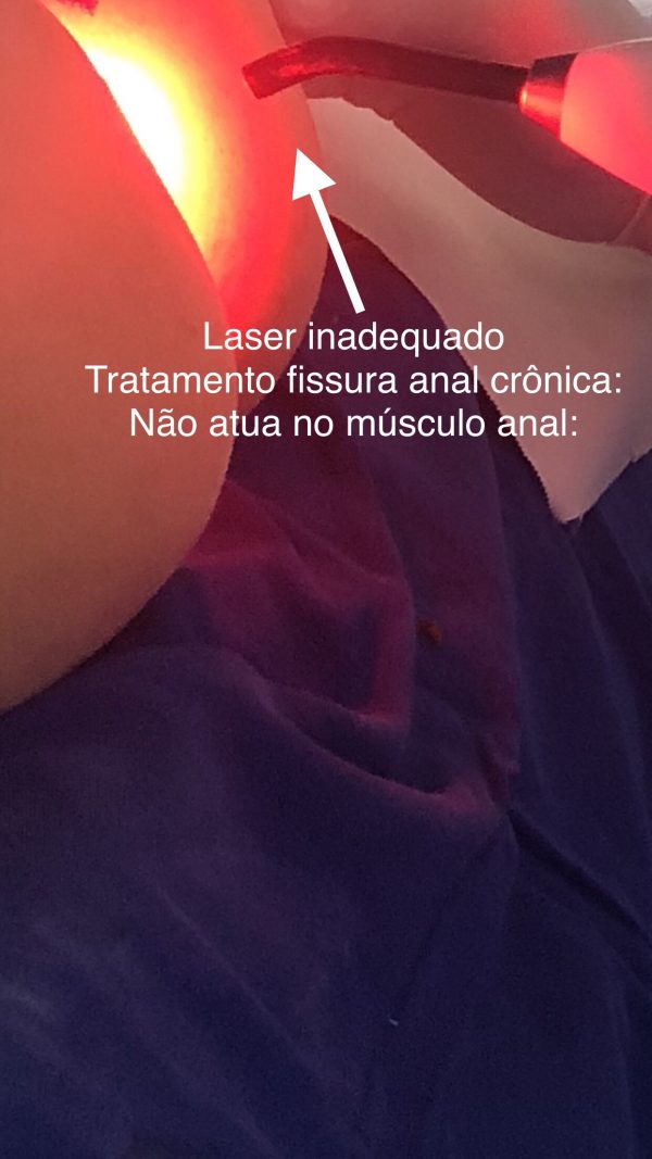 Fissura Anal Cr Nica E Anismo Tratada Laser Errado Dr Paulo Branco