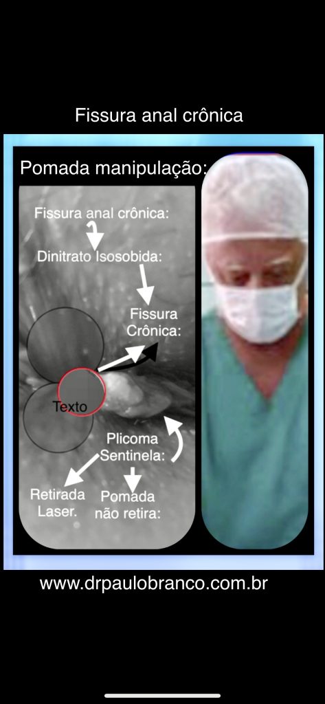 Fissura anal crônica que o paciente quer saber se examino e trato