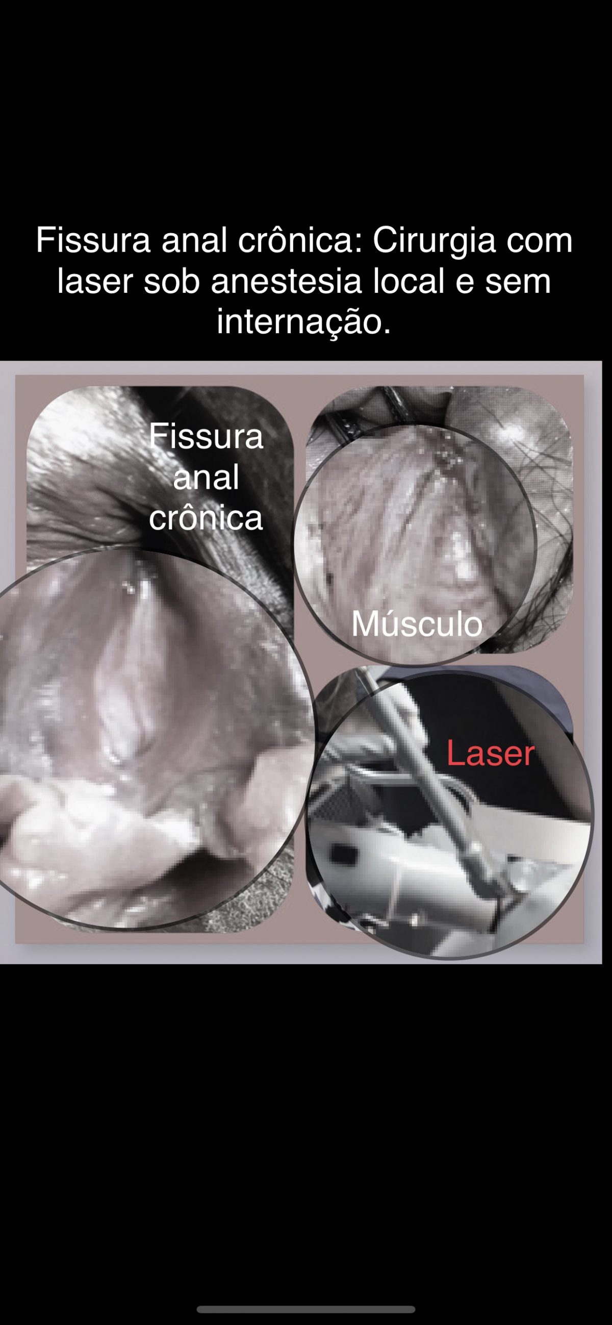 Fissura anal crônica que o paciente quer saber se examino e trato