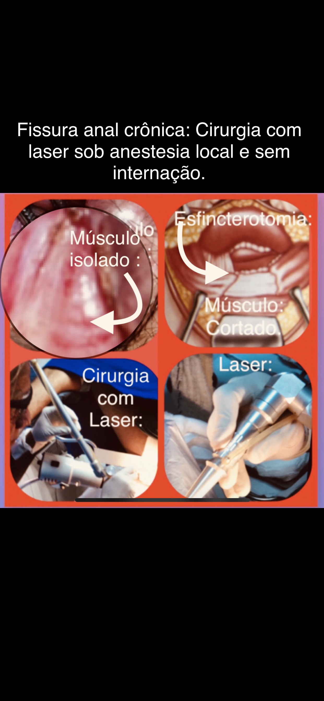 Fissura Anal Cr Nica Que O Paciente Quer Saber Se Examino E Trato