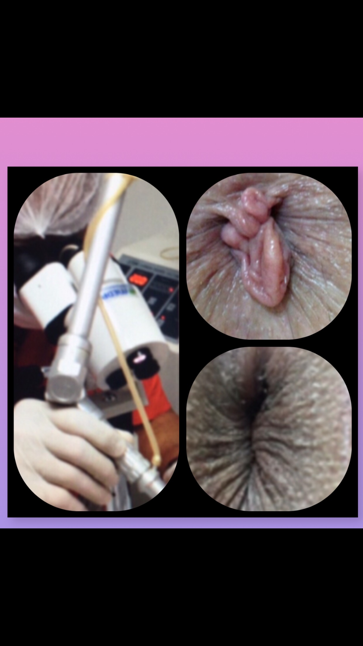 Valor cirurgia plicoma anal