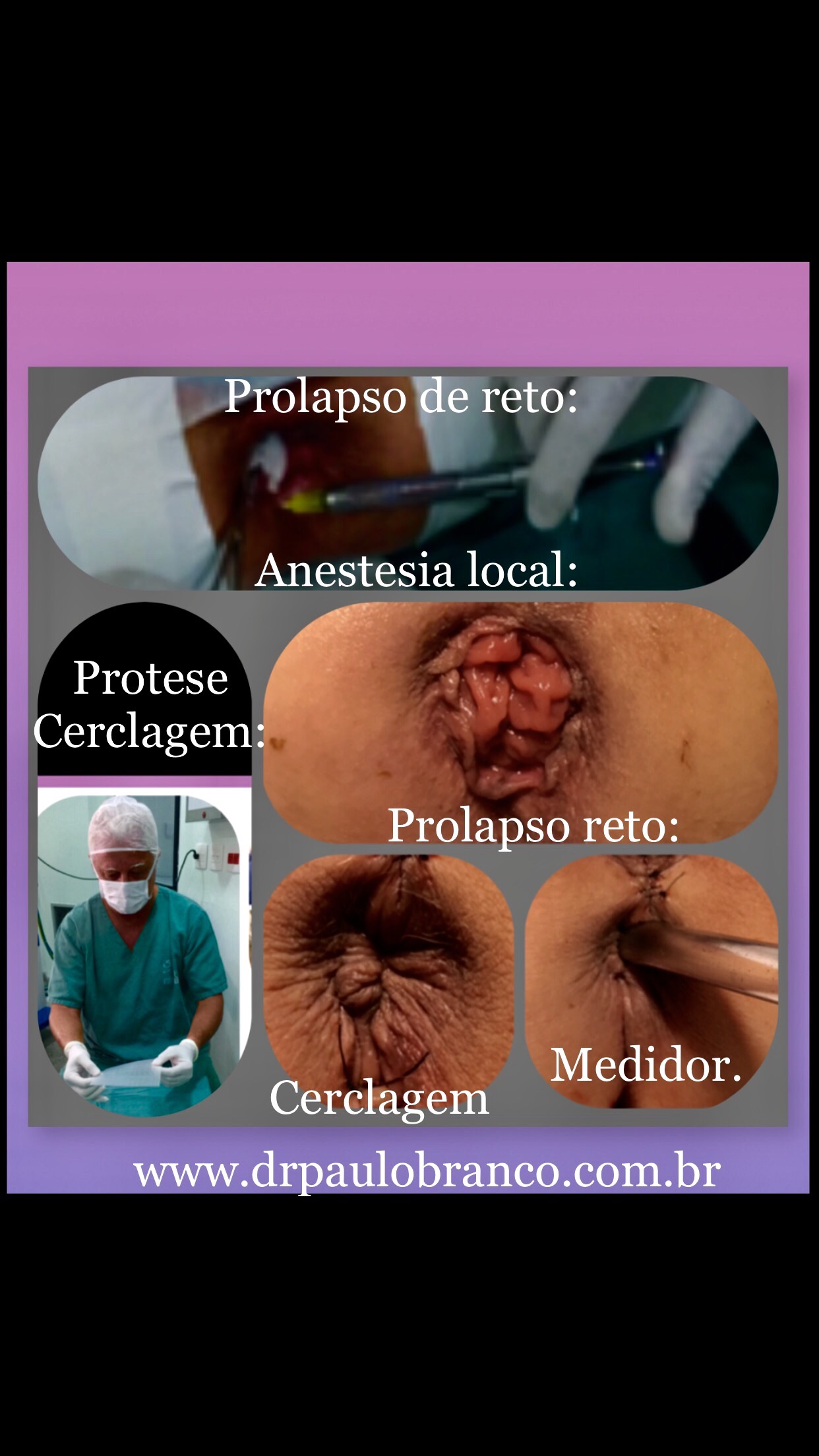 Prolapso retal tratado com cirurgia de cerclagem sob anestesia local e sem  internação com artigo médico ilustrado com fotos educativas e link para  site, blogs e canal de vídeos das doenças patológicas