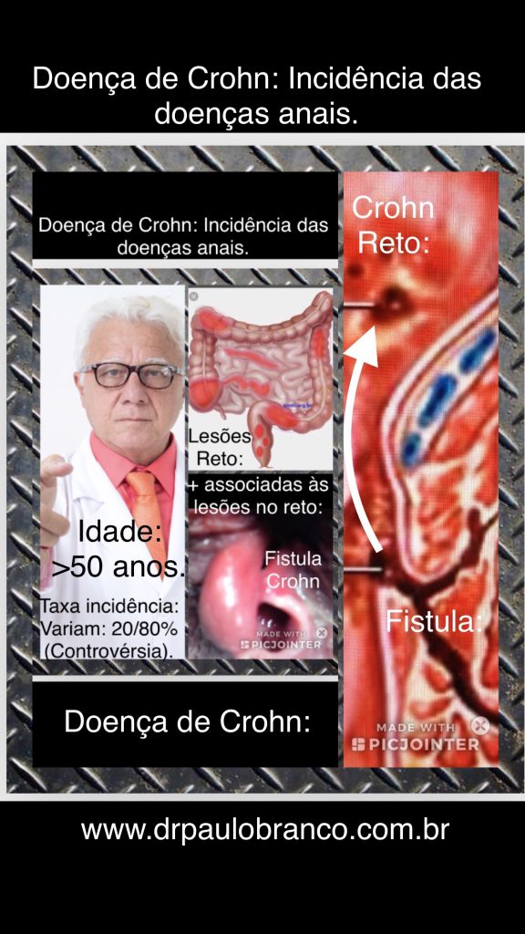 doença de Crohn e a incidência das doenças anais.