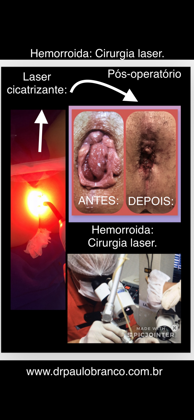 Consultorio tratamento das Hemorroidas pela Ligadura elástica, cirurgia