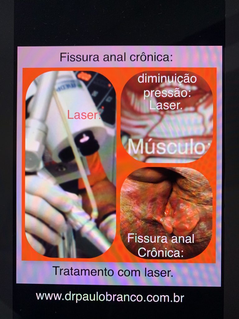 fissura anal crônica tratada com laser sem internação. 