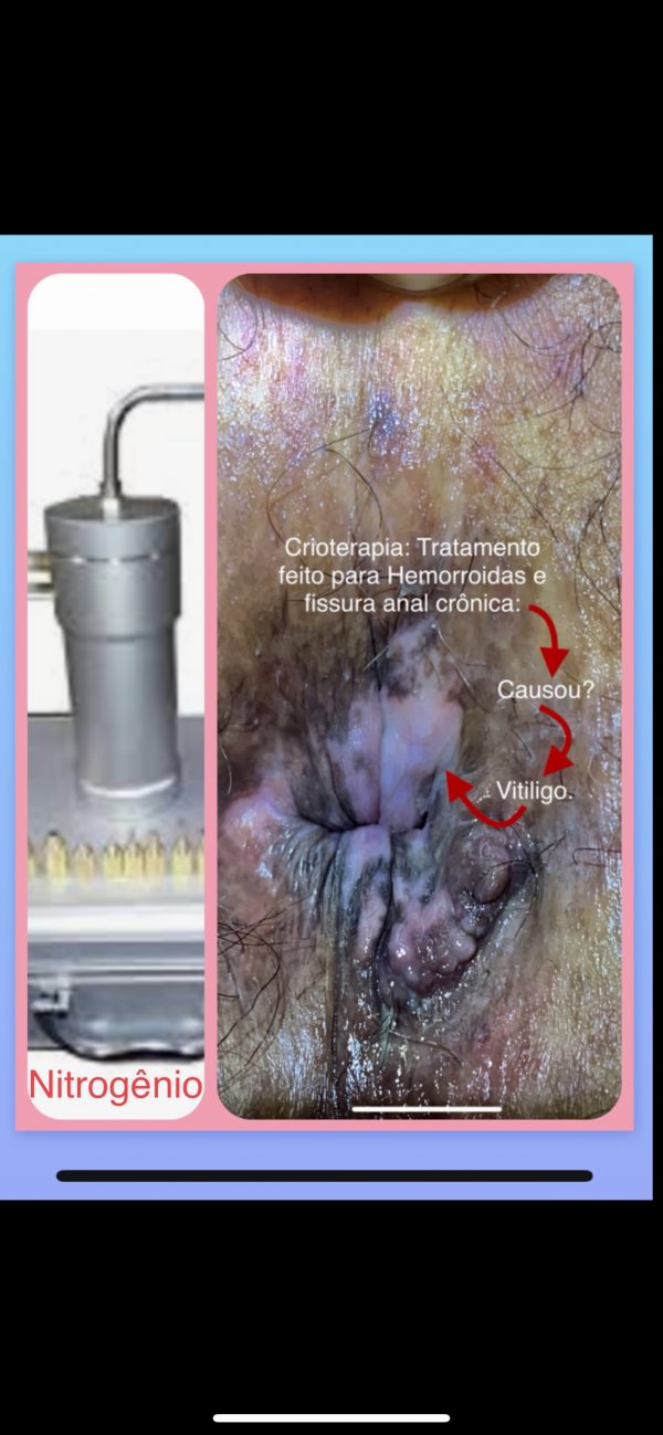 Nitrogênio tratamento das verrugas de hpv anus