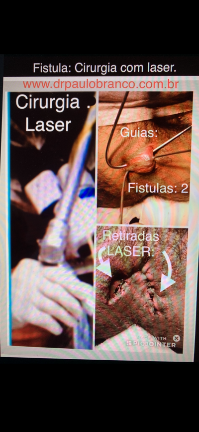 fistula perianal retirada com laser