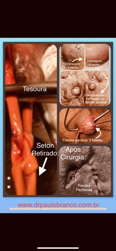 fistula perianal tratamento com fio de seton