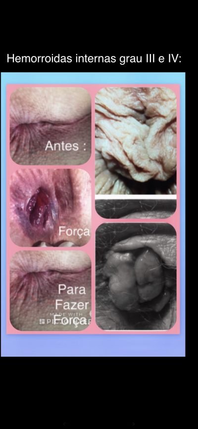 hemorroida interna de grau III e IV.
