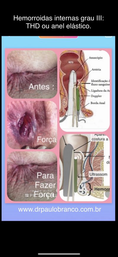 hemorroida grau III.