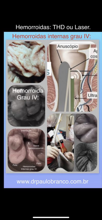 hrmorroidas internas de grau IV.