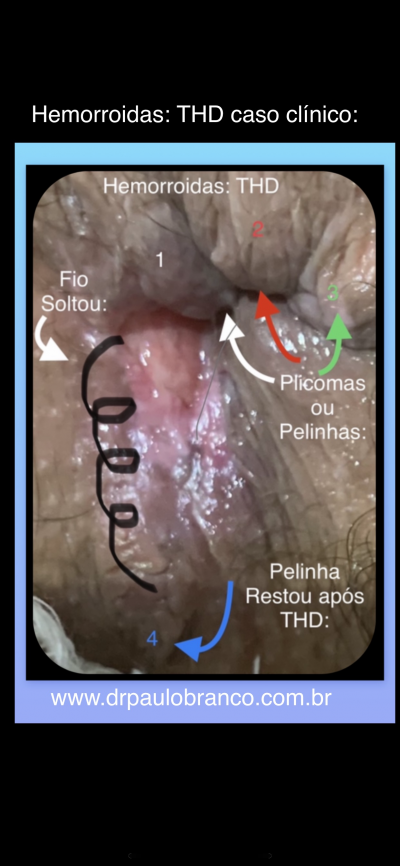 hemorroida tratada pelo THD.