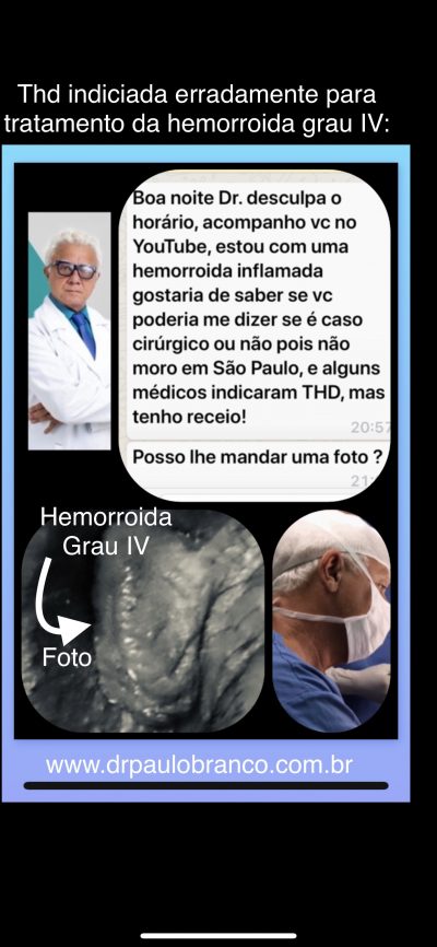 hemorroida interna de grau IV indicada a cirurgia THD erradamente pelos proctologistas.