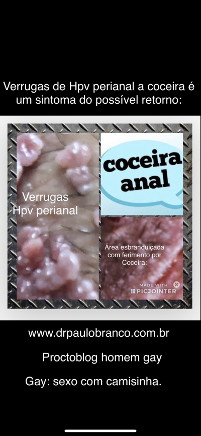 hpv causa coceira no anus