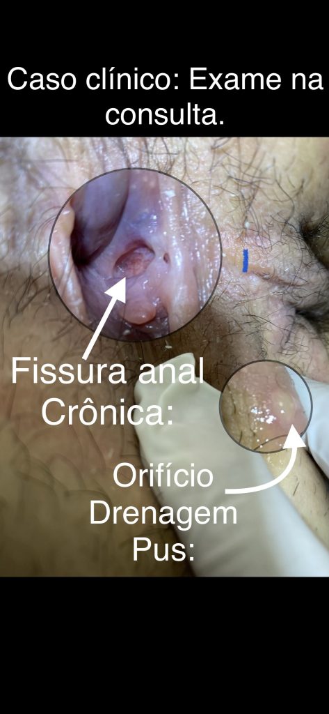 fissura anal cronica
