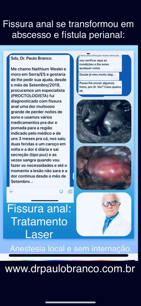 Fissura anal evoluiu para a fístula perianal 