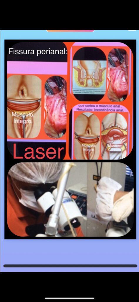 tratamento da fissura anal crônica com laser 