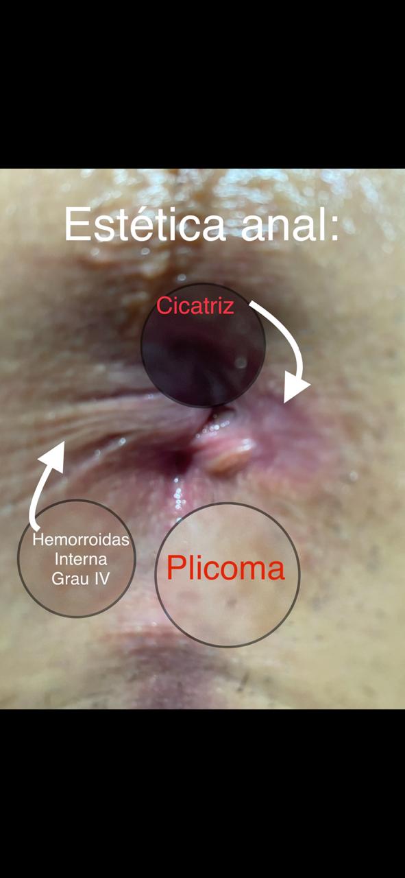 cicatriz anal após cirurgia para Hemorroidas