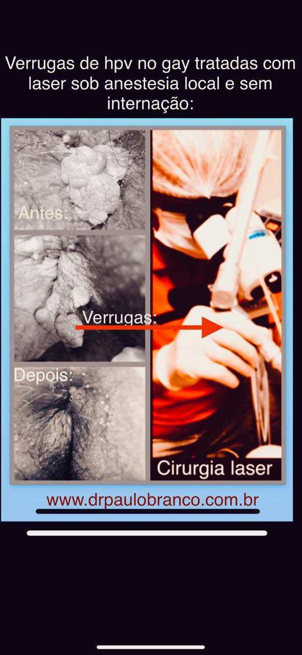 verrugas de hpv no anus tratadas com laser