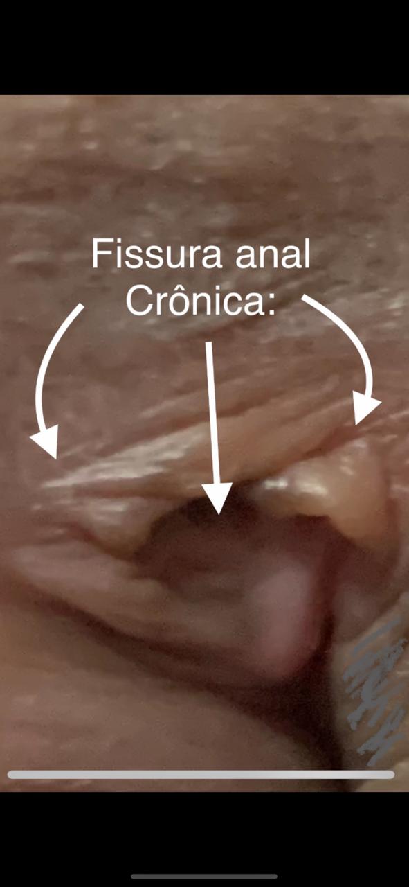 fissura anal cronica