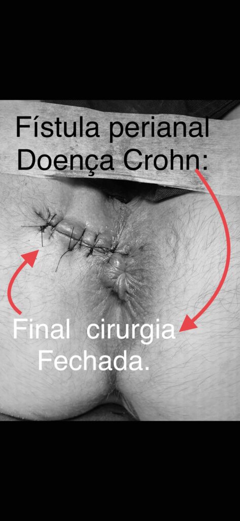 fistula perianal tratada pela doença de Crohn