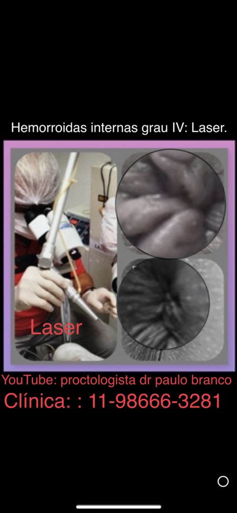 pelhinha no anus tratada com laser
