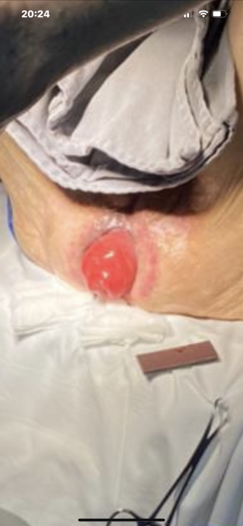 prolapso de reto tratado pela cerclagem anal