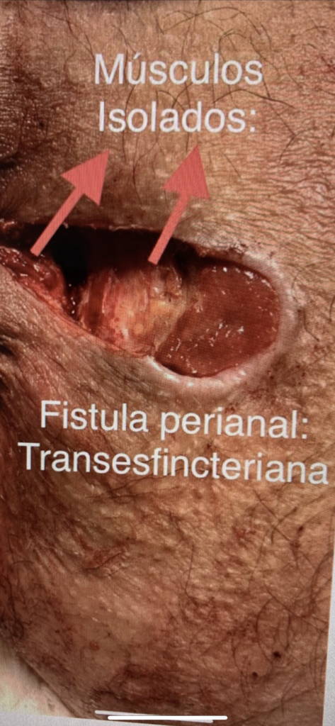 fistula perianal transesfincteriana 