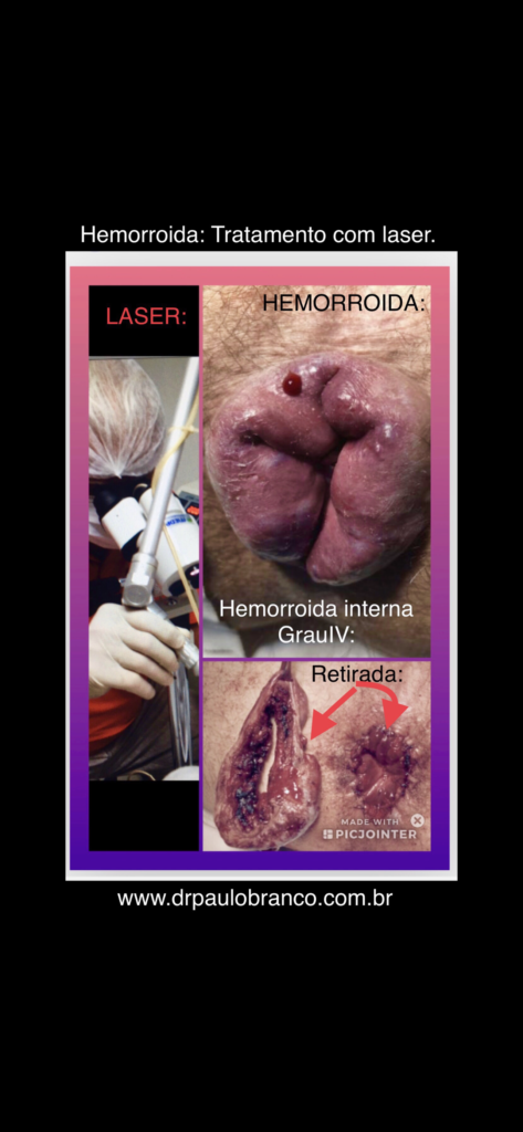 hemorroidas tratadas com laser