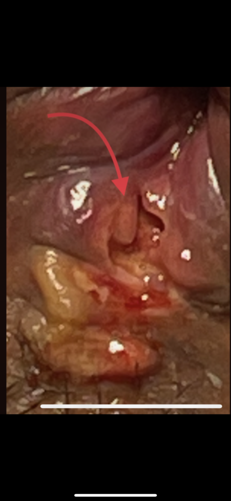 fissura anal por dorna de Crohn