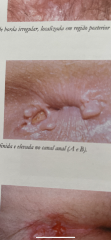 fissura anal por doença de Crohn 
