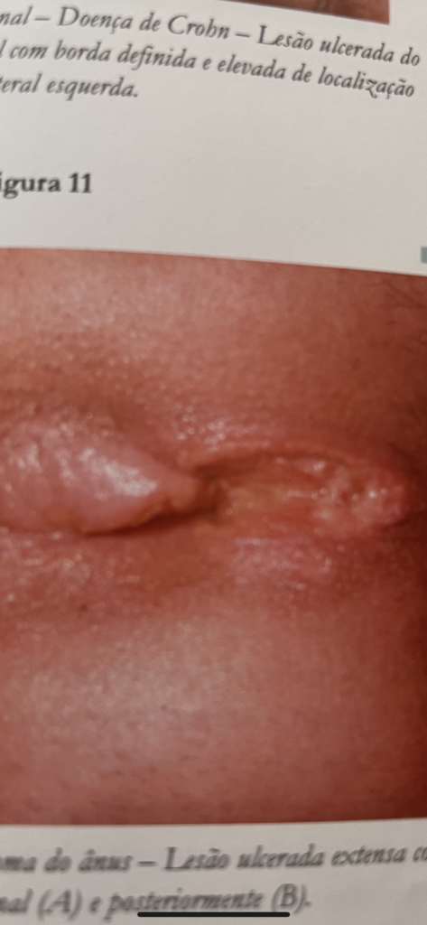 fissura anal por doença de crohn