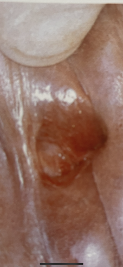 fissura anal com infecção 