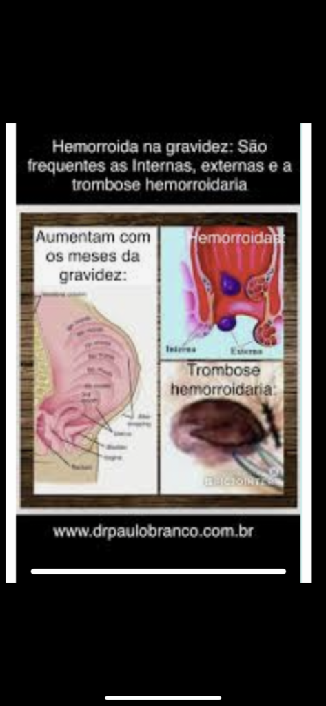 hemorroida trombosada na gravidez
