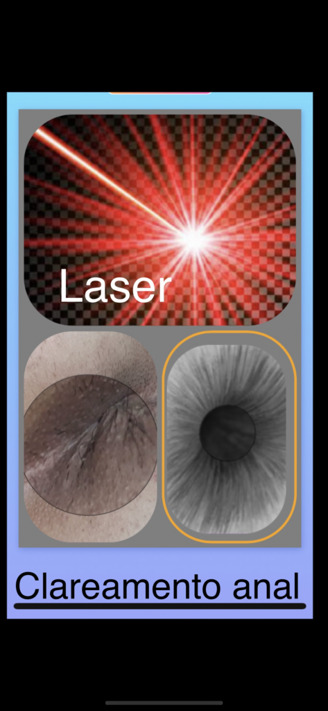 clareamento anal com laser