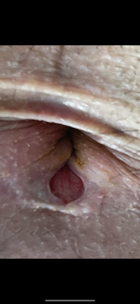 fissura anal 